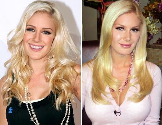 abc_heidi_montag_surgery_100119_ssh